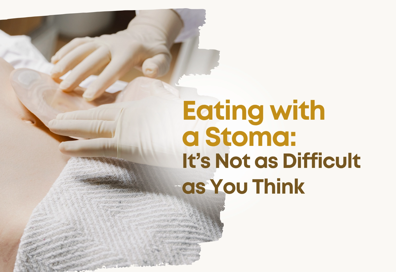 Eating with a Stoma: It’s Not as Difficult as You Think