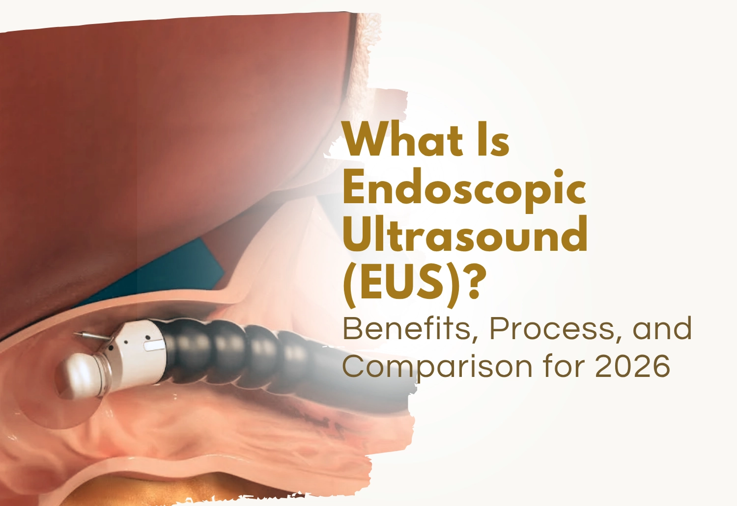 What Is Endoscopic Ultrasound (EUS)?: Benefits, Process, and Comparison for 2026